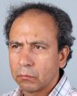 Before Hair Transplant&nbsp;Front